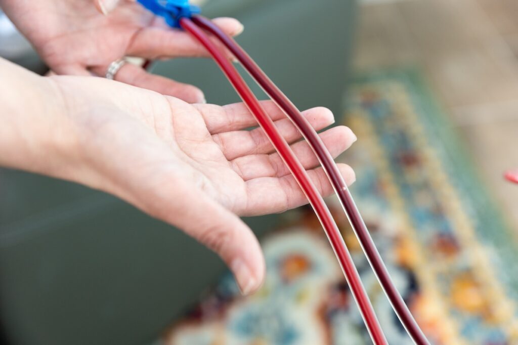 A person holds two tubes connected to a dialysis machine. The one tube is a darker red than the other after EBOO treatment in Nashville.